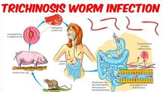 Trichinosis (Pork Parasite) Pathophysiology, Signs, 57% OFF