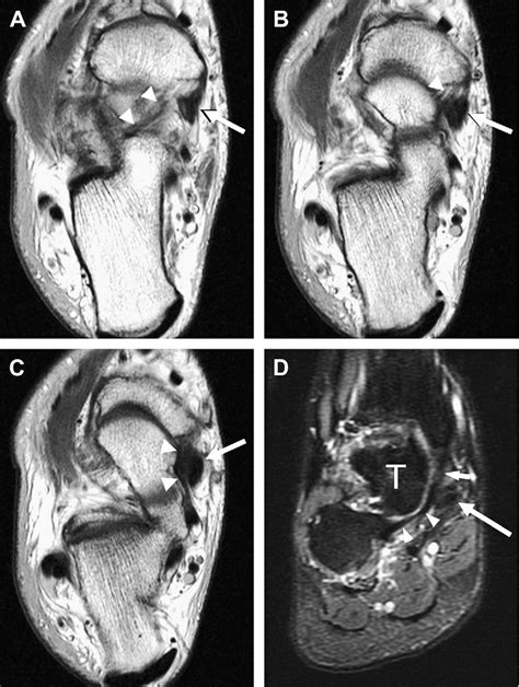 Figure From Mr Imaging Of Midfoot Injury Semantic Scholar