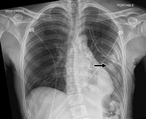 Imaging Manifestations Of Chest Trauma Radiographics