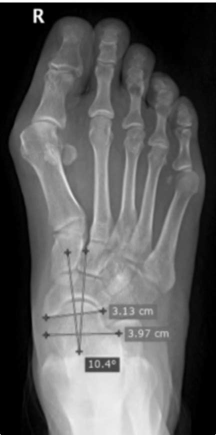 Plain X Ray Ap View Of The Rt Foot Standing Position Showed Increased