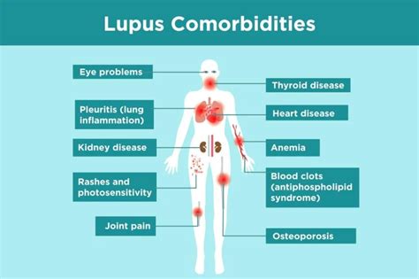 Lupus Complications What Lupus Patients Need To Know Lupus Nephritis Lupus Thyroid Symptoms