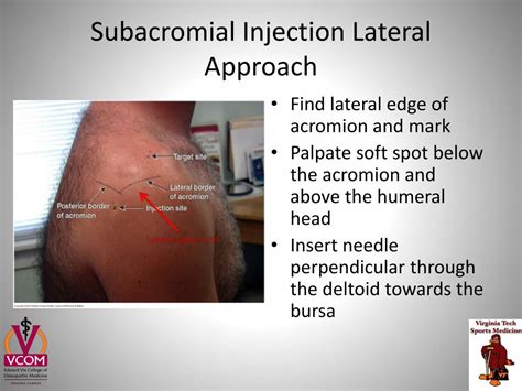 Subacromial Bursitis Injection