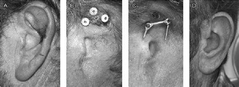 Squamous Cell Carcinoma Of The Auricle A Lateral Aspect Of The