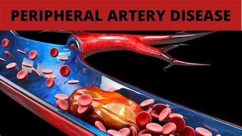 Treatment For Peripheral Artery Disease Youtube