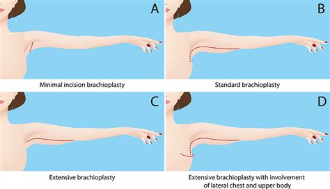 Arm Lift Surgery Whats Involved And What Does Recovery Look Like