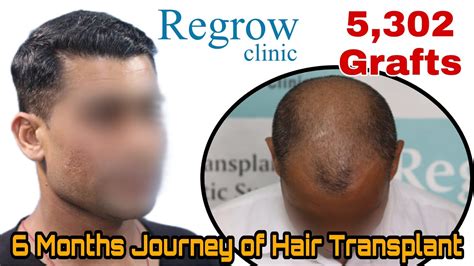 Best Hair Transplant Result 2021 Nw Grade Vi 5302 Grafts Regrow Clinic Youtube