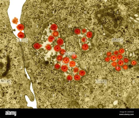 Herpes Simplex Virus Hsv Dna Virus In Cellular Vacuoles And