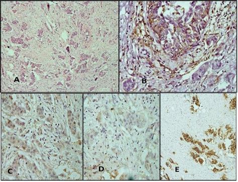 Invasive Carcinoma Of No Special Type Grade Ii A He 100x B Stroma Is Download Scientific