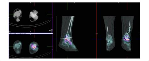 Spect Ct Showing Talar Component Tracer Activity Download Scientific