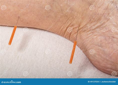 Acupuncture Treatment on Leg Stock Photo - Image of acupuncture, moxibustion: 49137034