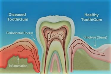 Tooth infection - Causes, Symptoms, Prevention & Treatment