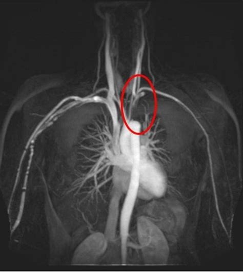 Mri Showing Complete Occlusion Of Proximal 4 Cm Of Left Subclavian