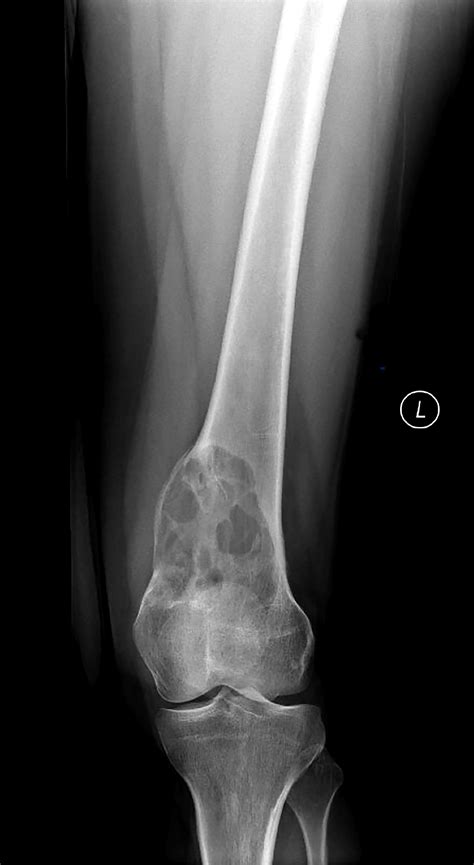 Pathology Outlines - Giant cell tumor of bone, NOS