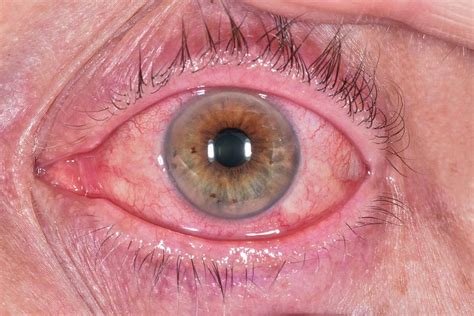 Allergic Conjunctivitis Photograph By Dr P Marazzi Science Photo Library