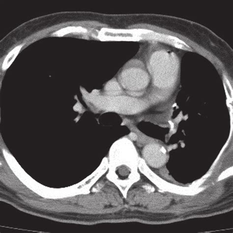 (PDF) Chest Wall Reconstruction using Gore-Tex (R) Dual Mesh