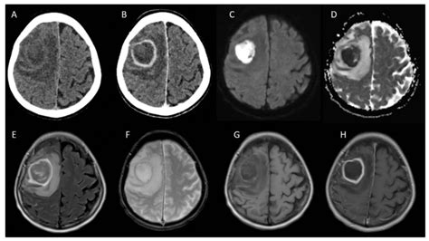 Méningites méningoencéphalites abcès cérébral chez l adulte et l