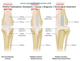 Patellar Subluxation: Symptoms | Causes | Diagnosis | Nonsurgical treatment