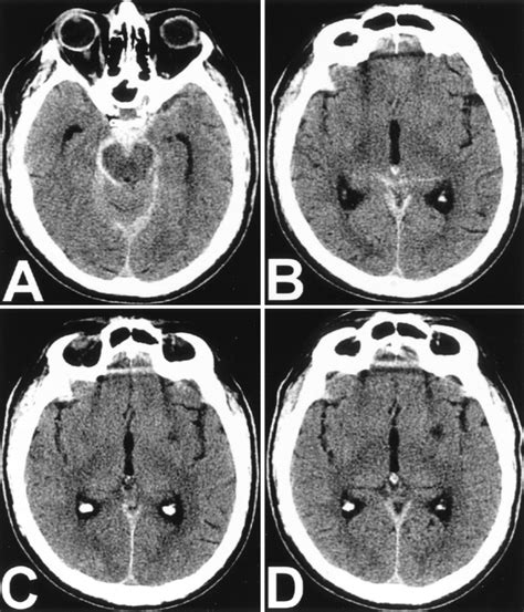 Acute Lacunar Stroke In Association With Angiogram Negative