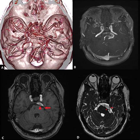 A Axial Three Dimensional Volume Rendered Reformatted Image From Ct