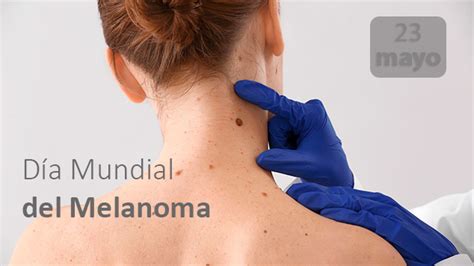 Día Mundial Del Melanoma Sescam Gerencia Puertollano