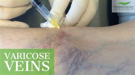 Varicose Vein Treatment Dr Ben Behnam Los Angeles Youtube