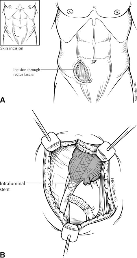 Figure 1 From Outcome After Hypogastric Artery Bypass And Embolization