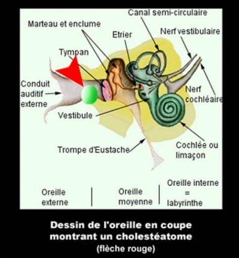 Cholestéatome De Loreille Moyenne Vulgaris Médical