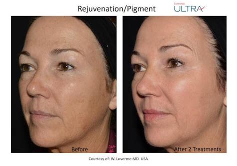 Lutronic Lasemd Ultra Treatment Los Angeles