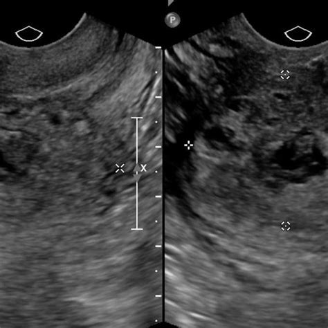 Case 3 Diagnostic Laparoscopy Showing The Cesarean Scar Pregnancy