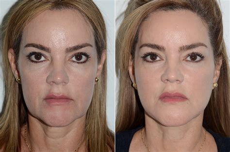 Deep Plane Facelift Photos Miami FL Patient 20043