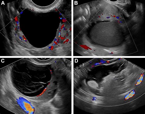 Adnexal Lesion Imaging Past Present And Future Radiology