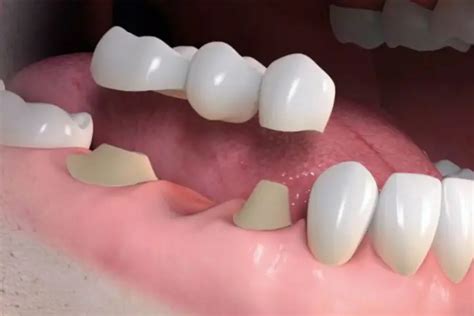 Ponte Dent Ria Fixa Para Completar O Sorriso Implart Implantes