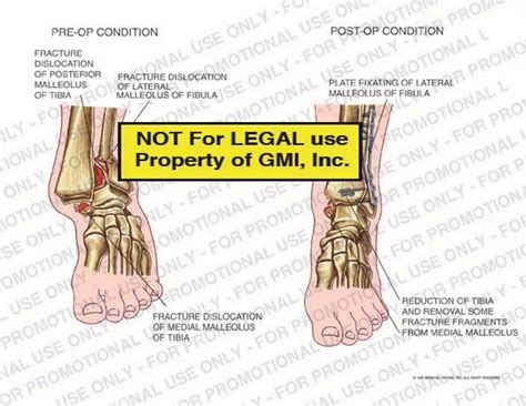 Pre Op Vs Post Op Conditions 96184c9a Generic Medical Legal Exhibits A Division Of Mvi