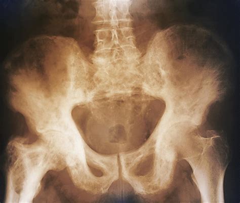 Pelvis In Paget S Disease X Ray Photograph By Zephyr Pixels