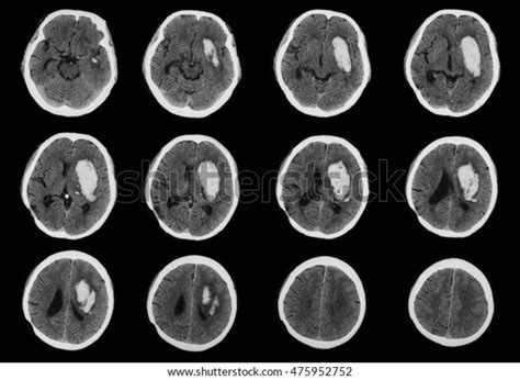 Ct Scan Computed Tomography Brain Brain Stock Photo (Edit Now) 475952752