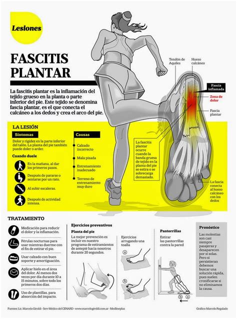 Infografía de Fascitis Plantar Traumatopedia