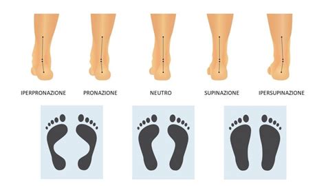 Pronazione Come Riconoscerla E Possibili Rimedi Allucevalgostop