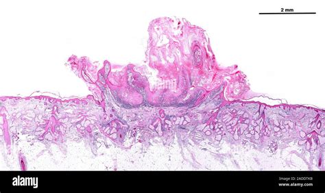 Light Micrograph Of Scalp Skin Showing A Common Wart Verruca Vulgaris