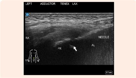 Percutaneous Ultrasound Tenotomy Using The Tenex System On The Adductor