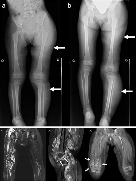 Syndromic Vascular Malformations Related To The Pik3ca And Ras Pathways