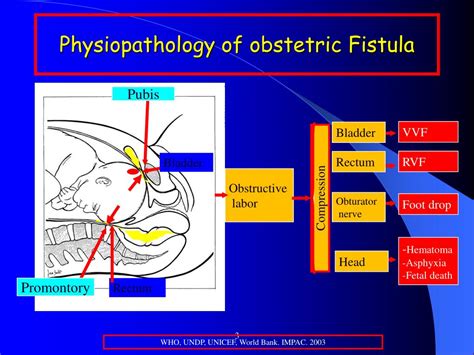 Ppt Risk Factors For Obstetric Fistula A Clinical Review Powerpoint