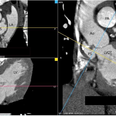 Incidental Pseudoaneurysm Of The Mitralaortic Intervalvular Fibrosa In