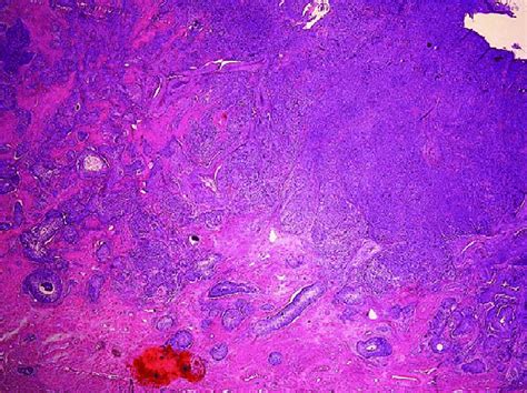 Pathology Showing Squamous Cell Carcinoma With Lymphovascular Space Download Scientific Diagram