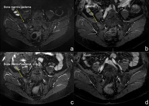 A B Unilateral Sacroiliitis In A 64 Year Old Woman With Right Upper Download Scientific