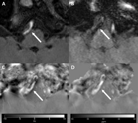 A Dissecting Intramural Hematoma In A 50 Year Old Male Patient A An