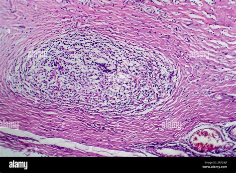 Hodgkins Lymphoma Light Micrograph Photo Under Microscope Stock