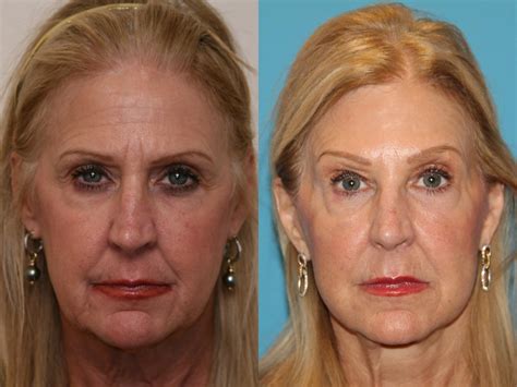 Facelift And Mini Facelift In Atlanta Buckhead Facial Plastic Surgery