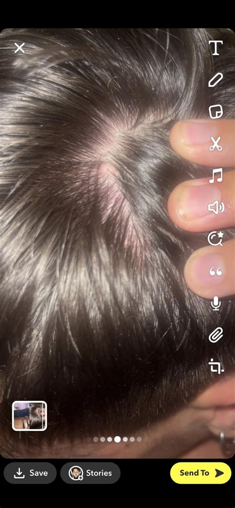 Bump on scalp? Cyst?? : r/Dermatology