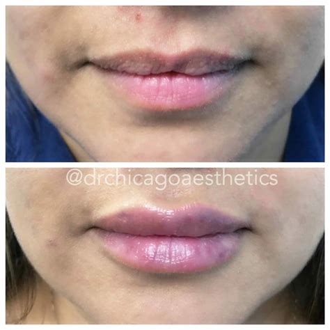 Lip Fillers Before And After Photos Chicago Aesthetics Medspa