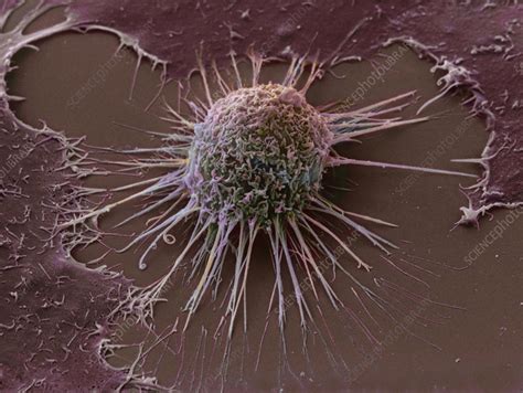 Cervical Cancer Cell SEM Stock Image M850 0431 Science Photo Library